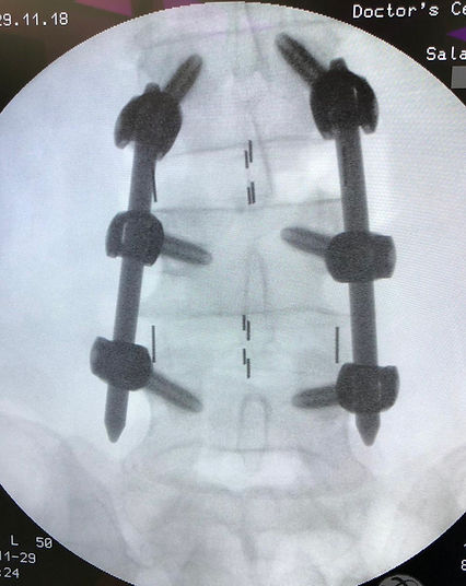 Columna vertebral (Placas)